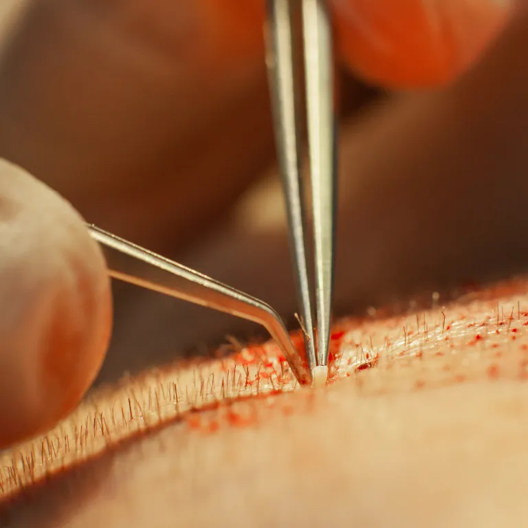 Stick & Place Hair Transplant Technique Image